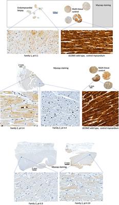 GRINL1A Complex Transcription Unit Containing GCOM1, MYZAP, and POLR2M Genes Associates with Fully Penetrant Recessive Dilated Cardiomyopathy